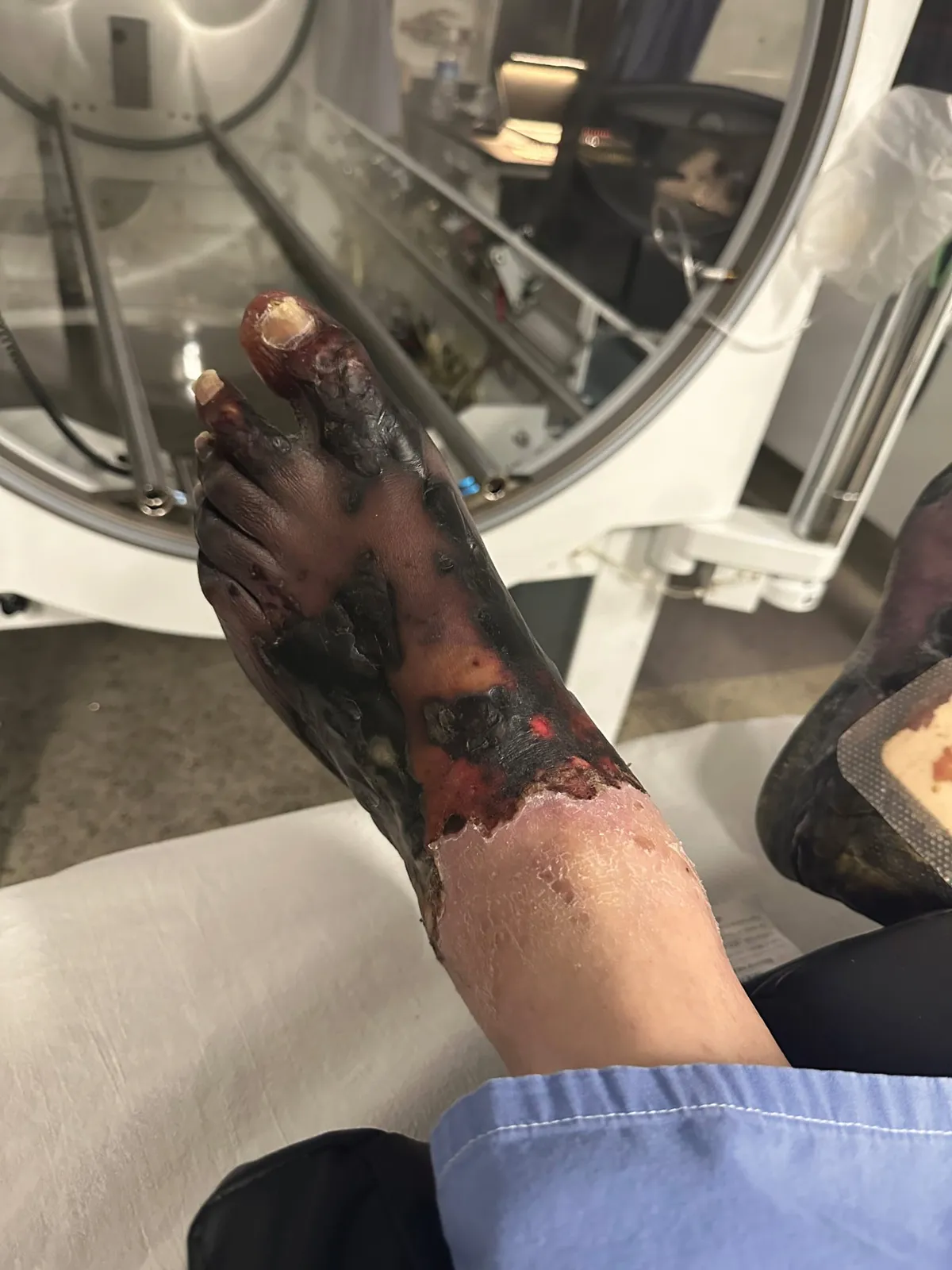 Severely damaged foot with extensive dark necrotic tissue near a hyperbaric chamber