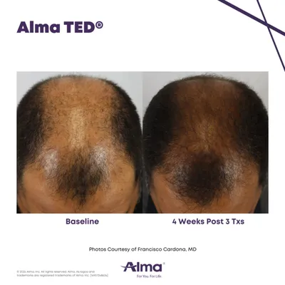 Side-by-side overhead views of a scalp showing sparse hair versus noticeably denser hair regrowth after treatment
