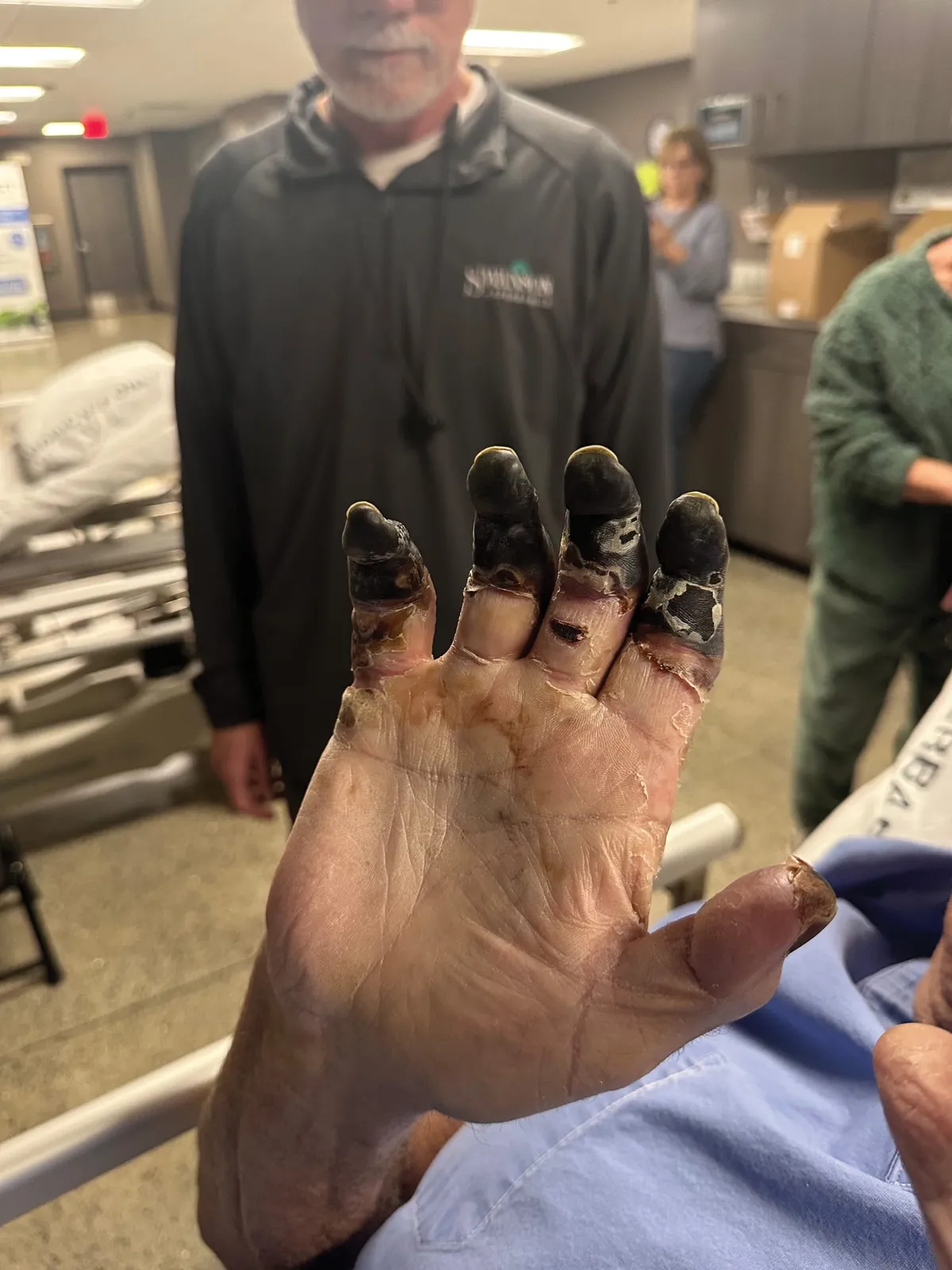 Hand with severe frostbite showing blackened necrotic fingertips in a medical facility